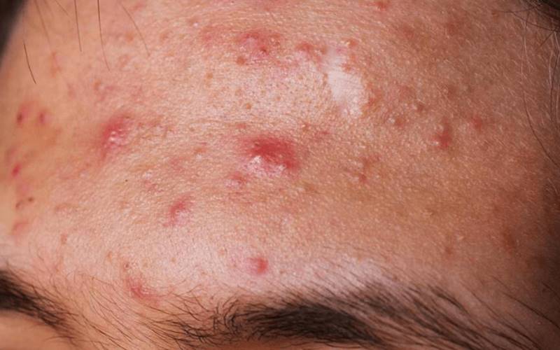 Những điều cần lưu ý khi điều trị mụn viêm