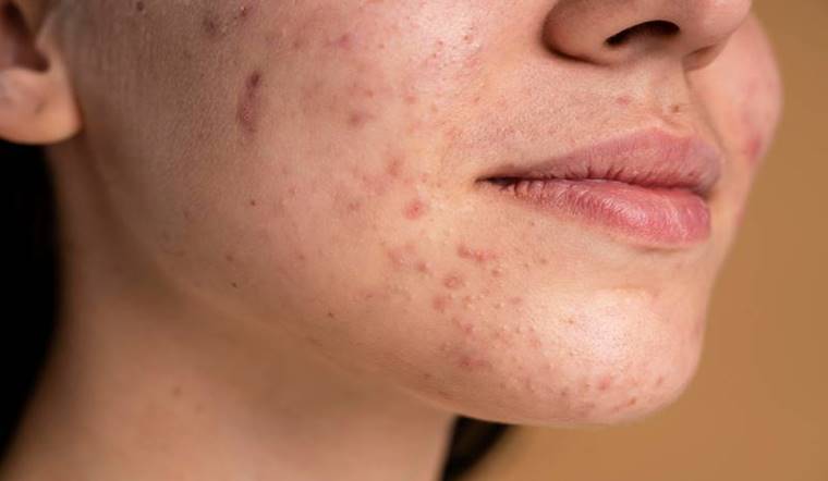 Bị mụn viêm nên làm gì? Cách điều trị các loại mụn viêm