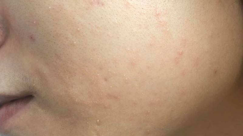 Dùng sản phẩm trị mụn hoặc thuốc không kê đơn