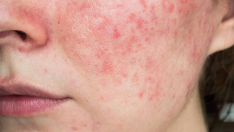 Cách ngăn ngừa mụn viêm hiệu quả