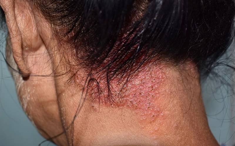 Các triệu chứng thường gặp