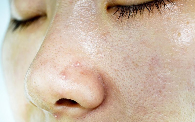 Ảnh hưởng của viêm da dầu đến chất lượng cuộc sống