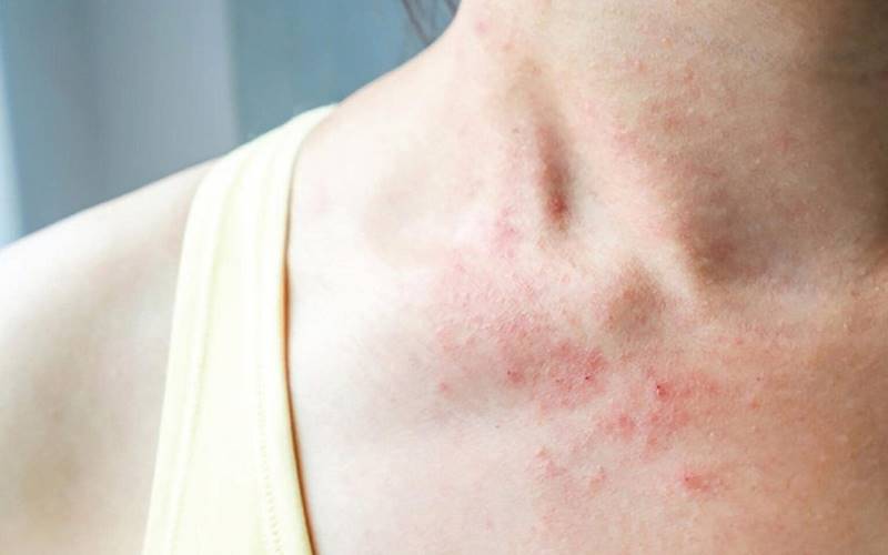 Mô tả chi tiết hình ảnh, đặc điểm của từng triệu chứng