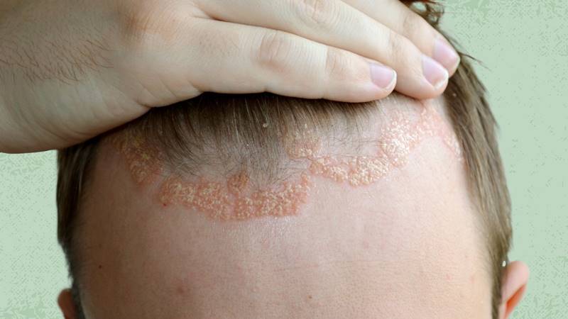 Định nghĩa chi tiết về viêm da dầu (Seborrheic Dermatitis)