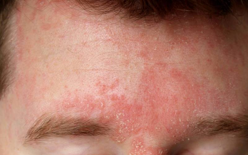 Cơ chế bệnh sinh cơ bản của viêm da dầu