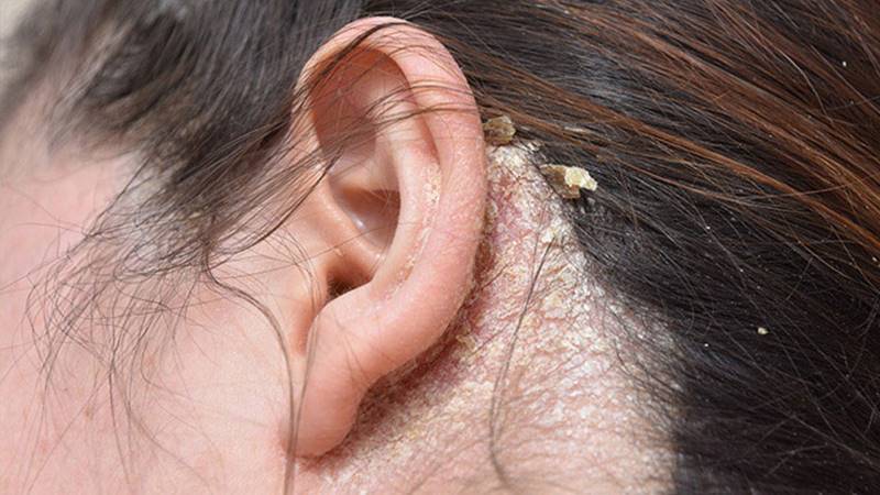 Biện pháp phòng ngừa viêm da dầu tái phát