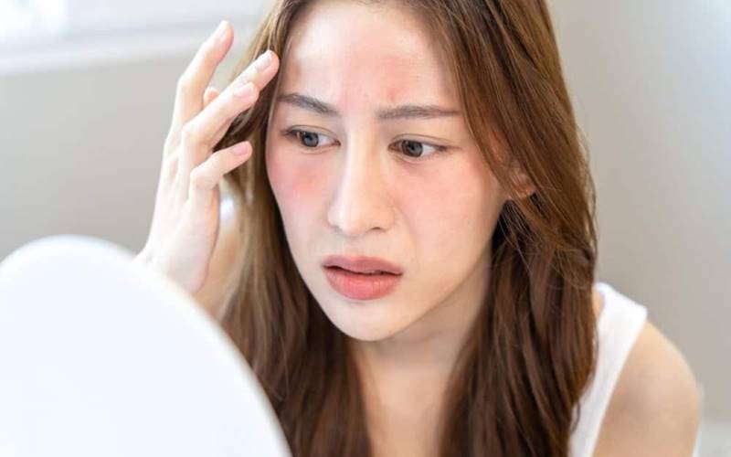 Giải đáp thắc mắc thường gặp về viêm da dầu (FAQ)