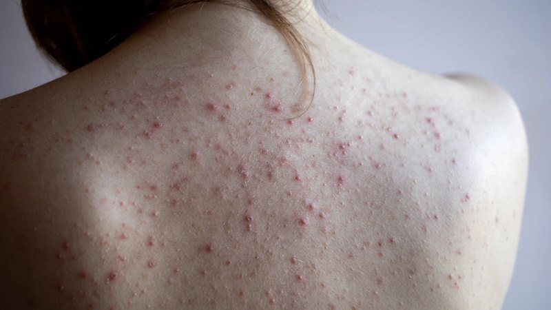 Mụn xuất hiện trên lưng