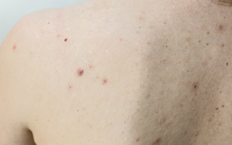 Lưu ý khi trị mụn ở lưng tại nhà