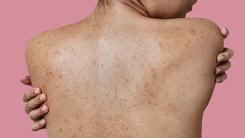 Cách phòng ngừa mụn lưng tái phát