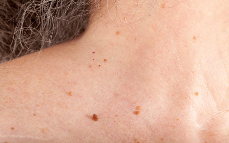 Những loại mụn nên nặn