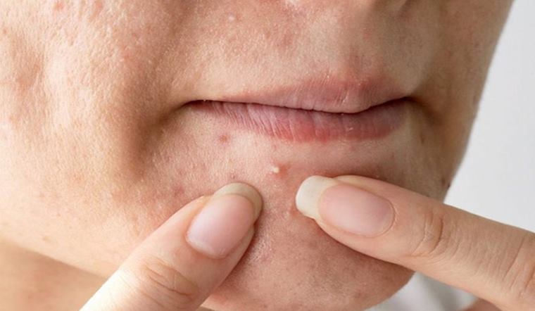 Nặn mụn có tốt không? Các cách nặn mụn an toàn