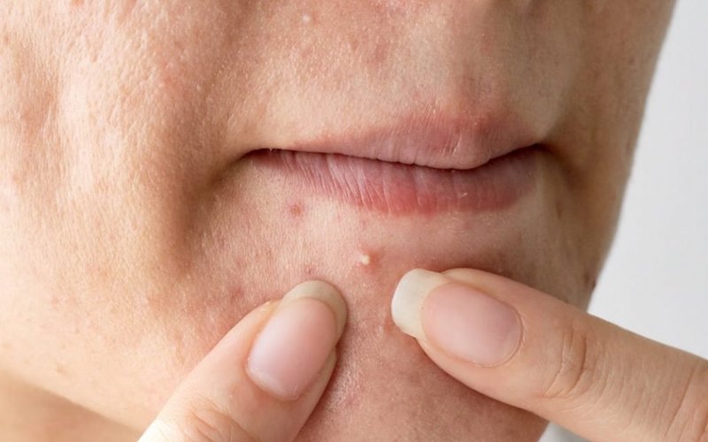 Các lưu ý sau khi nặn mụn