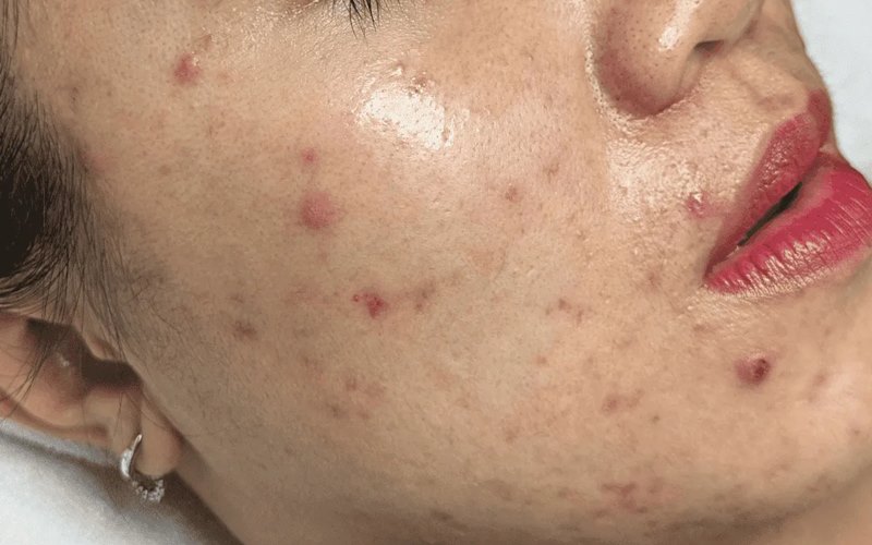 Cách nặn mụn an toàn