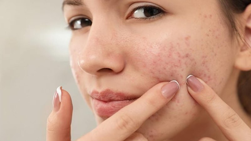 Cách phòng ngừa mụn trứng cá