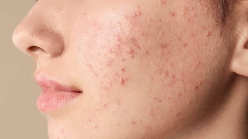 Không nên tự ý nặn mụn tại nhà