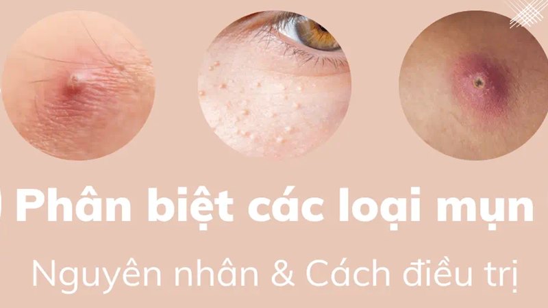 Các loại mụn trên da