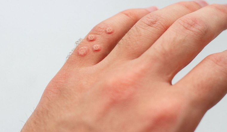 Mụn cơm là gì? Dấu hiệu nhận biết và cách điều trị mụn cơm