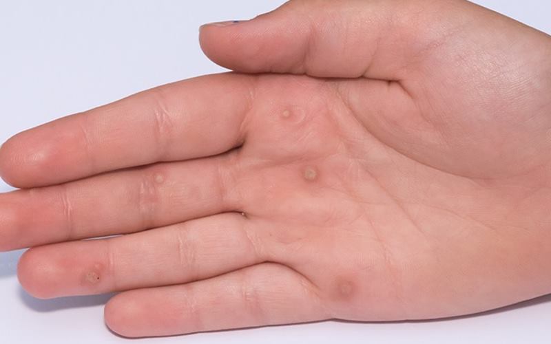 Mụn cơm còn gọi là mụn cóc