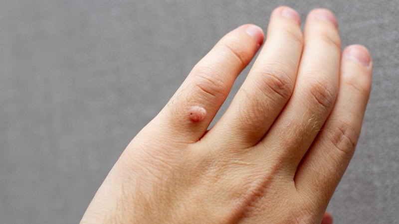 Nguyên nhân gây nổi mụn cơm