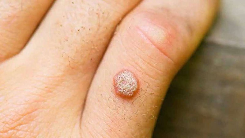 Dấu hiệu nhận biết mụn cơm