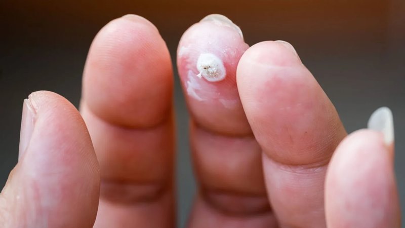 Cách điều trị mụn cơm phổ biến