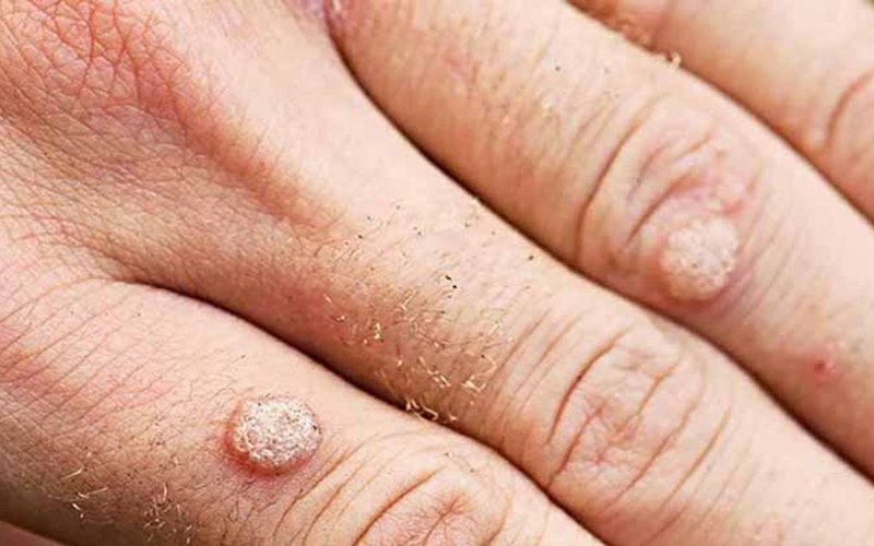 Những yếu tố làm tăng nguy cơ nổi mụn cơm