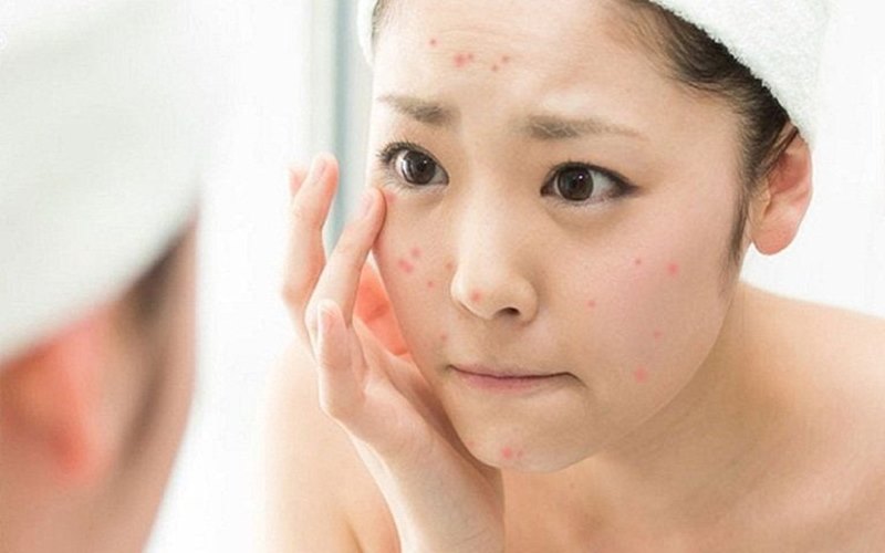 Hỗ trợ điều trị mụn