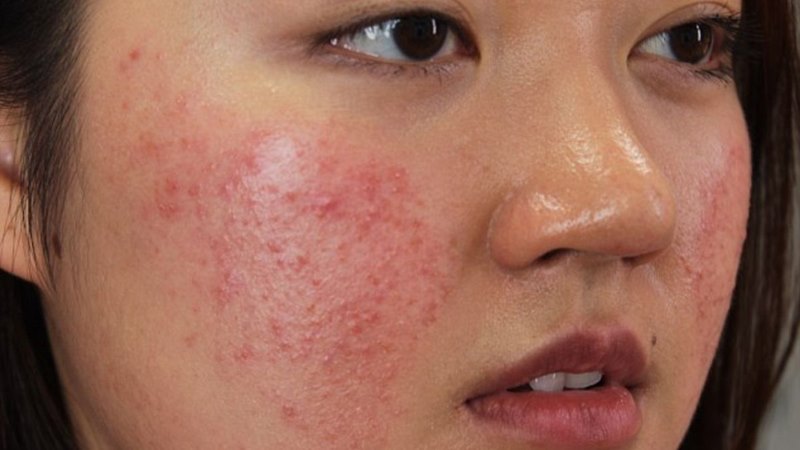 Triệu chứng nhận biết da bị dị ứng
