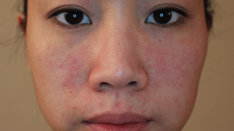 Phân loại các nhóm nguyên nhân gây dị ứng da