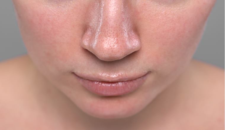 Da dầu có cần dưỡng ẩm không? Cách chọn kem dưỡng ẩm cho da dầu