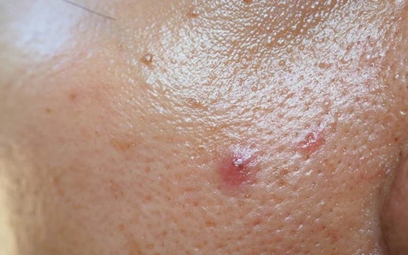 Một số lưu ý khi dưỡng ẩm cho da dầu Một số lưu ý khi dưỡng ẩm cho da dầu