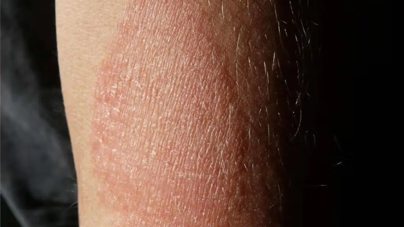 Các triệu chứng nặng hơn