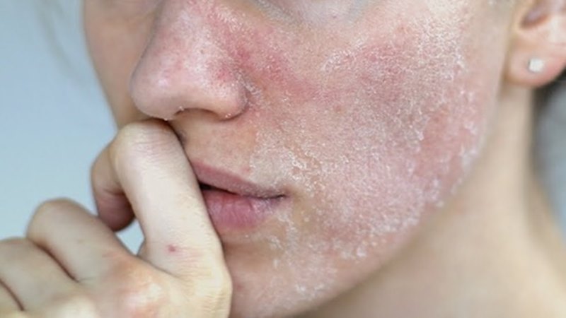 Các câu hỏi thường gặp về da khô