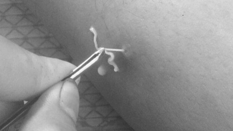 Kéo giun ra bằng tay Kéo giun ra bằng tay