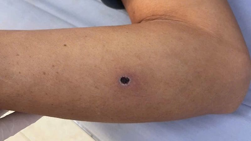 Dấu hiệu nhiễm bệnh giun rồng Dấu hiệu nhiễm bệnh giun rồng