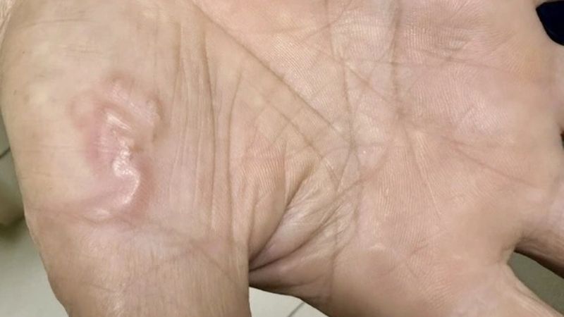 Bệnh giun rồng có khả năng điều trị khỏi hoàn toàn Bệnh giun rồng có khả năng điều trị khỏi hoàn toàn