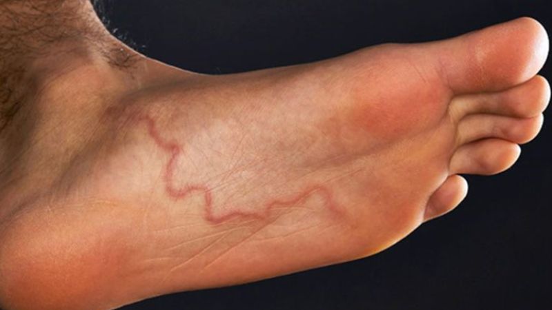 Tình hình bệnh giun rồng ở Việt Nam Tình hình bệnh giun rồng ở Việt Nam