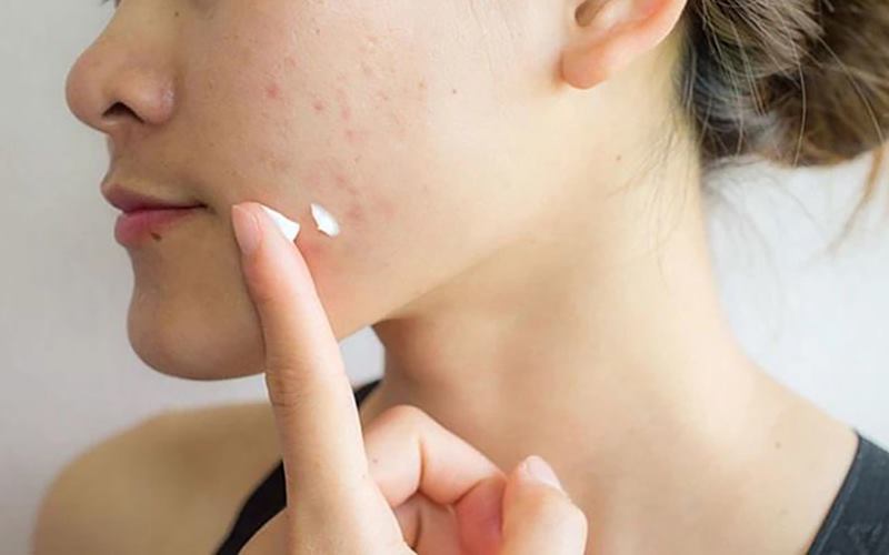 Ngăn ngừa mụn và kiểm soát dầu