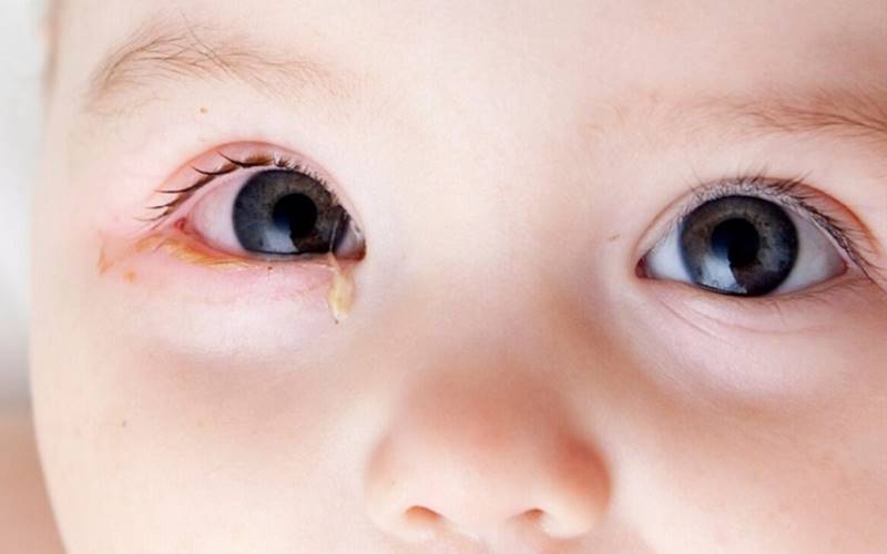 Ghèn xanh lá hoặc vàng đậm kèm theo sưng tấy, đau nhức