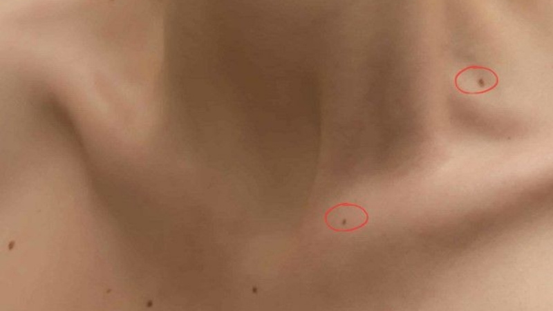 Nốt Ruồi Ở Giữa Hõm Cổ