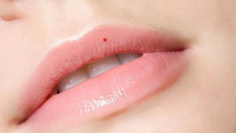 Nốt ruồi đỏ nổi bật, tượng trưng cho tài lộc, vận khí tốt