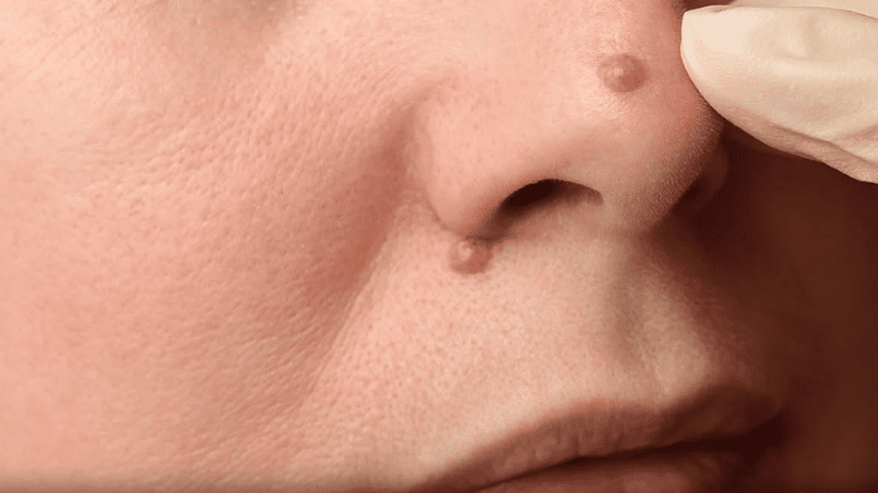 Tẩy nốt ruồi ở mũi có thể thay đổi vận mệnh của bạn