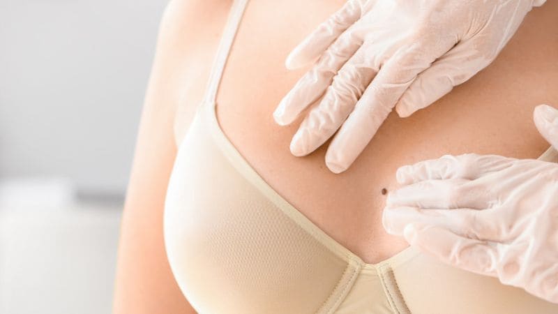 Các vấn đề sức khỏe tiềm ẩn liên quan đến nốt ruồi ở ngực