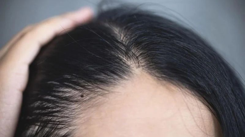 Nốt ruồi trong tóc mang lại tài lộc và cuộc sống sung túc cho phụ nữ