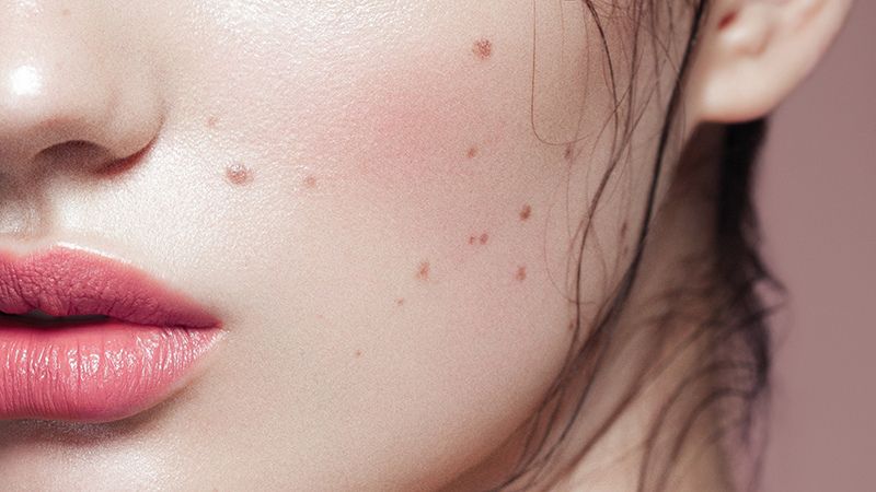 Nếu nốt ruồi phú quý ảnh hưởng đến thẩm mỹ, bạn có thể thu nhỏ thay vì xóa 