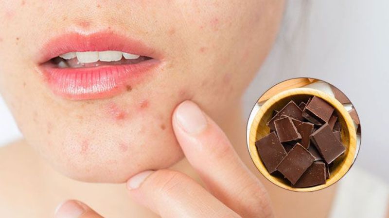 Nếu quá lạm dụng, socola có thể gây bít tắc lỗ chân lông và hình thành mụn