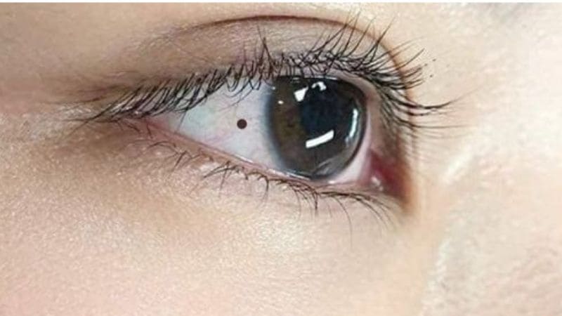 Giải mã tính cách và vận mệnh qua nốt ruồi