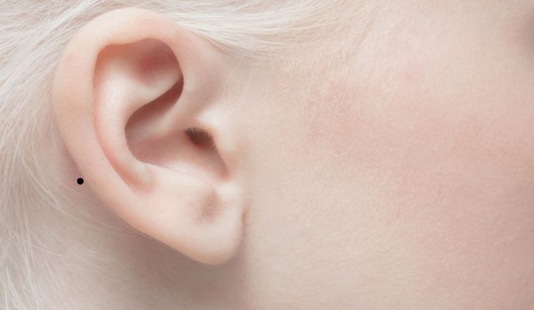 Nốt ruồi sau tai tốt hay xấu? Ý nghĩa nốt ruồi sau tai