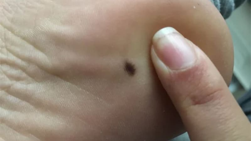 Nốt ruồi đen ở lòng bàn chân thường gắn với công việc di chuyển và sáng tạo